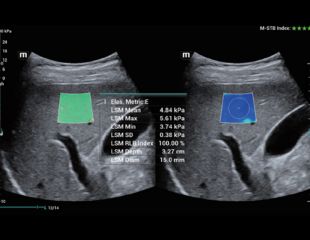 Leberelastographie HiFR STE mindray Ultraschall