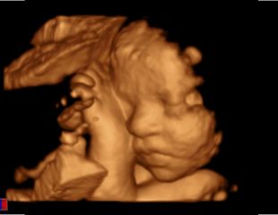 3D_4D Darstellung Baby Ultraschallgerät Gyn, OB