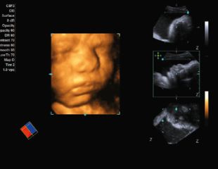 4d-Darstellung des fetalen Gesichts von Siemens Ultraschallgerät für GYN,OB