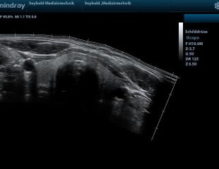 iScape mindray Ultraschallgerät - Schilddrüse