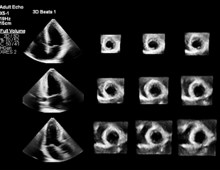 Multi Slice von Philips Ultraschallgeräten Kardiologie