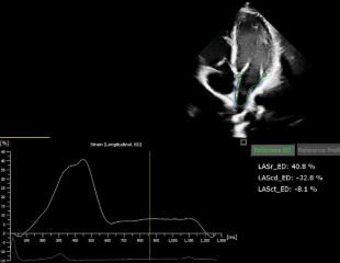 a2DQ LA von Philips Ultraschallgeräte Kardiologie